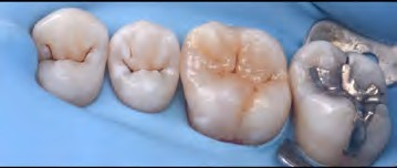  Fig. 2k: Final postoperative view demonstrating a well-contoured, highly polished direct composite restoration with harmonious occlusal anatomy and seamless  marginal adaptation.