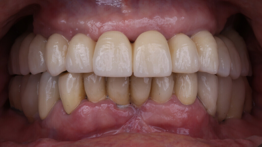 Fig. 19: Definitive prosthesis at the one-year follow-up, frontal view.
