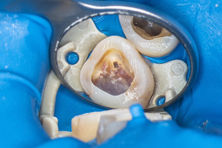 Fig. 12: The maxillary second molar after removal of the old restoration and after cusp reduction.