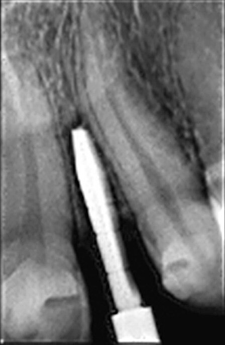Fig. 7 : Présentation radiologique de la technique d’ouverture de l’espace interradiculaire. Il faut noter l’insertion des alésoirs manuels de 2,5 mm et 3,0 mm entre les racines, afin de préparer l’espace pour l’implant de Ø 3,0 mm, mis en place à 3,0 mm sous le niveau de l’os crestal.