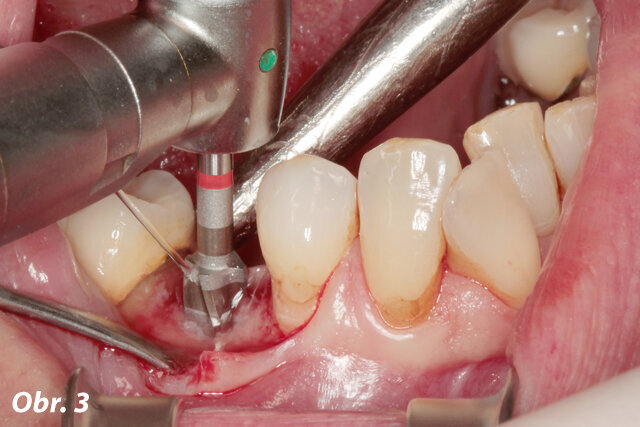Obr. 3: Příprava lůžka implantátu