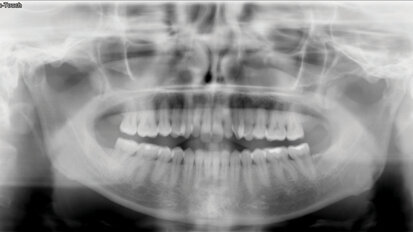 Řešení otevřeného skusu u dospělého pomocí Insignia™ systému a Straight-Wire™ finishingu