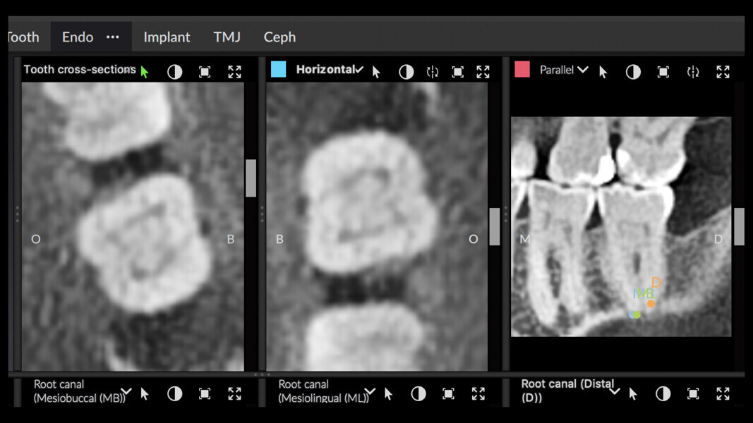 Fig. 10: Horizontal view of just 0.5 mm in thickness showing a complex system of lateral canals in the coronal part of the distal canal.