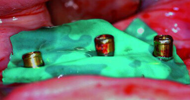 The use of existing locators to stabilize a CBCT-software derived surgical guide - Conversion of a mandibular removable to a fixed prosthesis