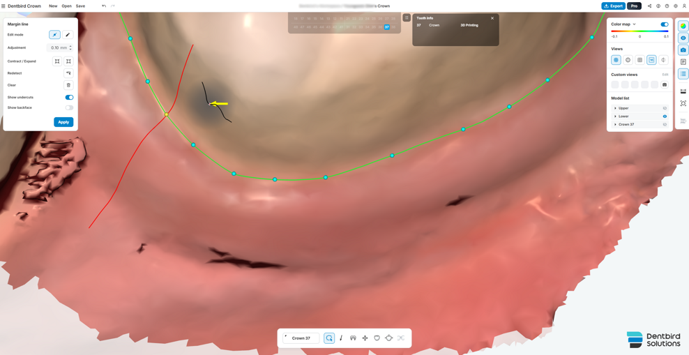 Fig. 3: Automatic margin detection with manual refinement to optimise marginal definition and the path of insertion.