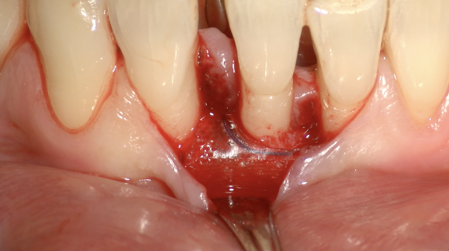 Fig. 6f - Membraba Guidor in situ.