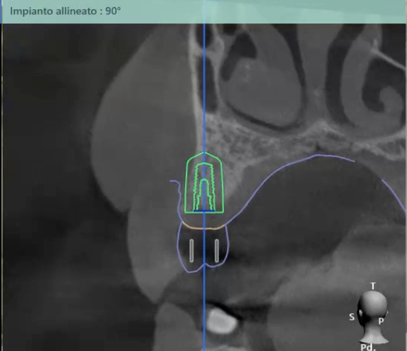 Fig. 8_Il posizionamento implantare nel software 3Shape Implant Studio.