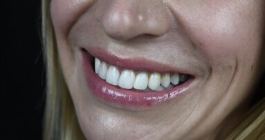 Treatment of a patient with a congenitally missing lateral incisor using aligners: A case report