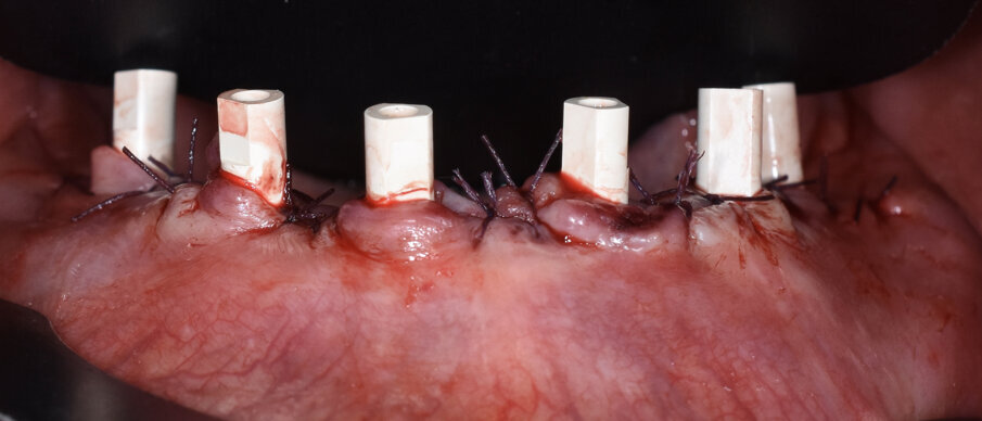 Fig. 9 - Scan body per impronta digitale.