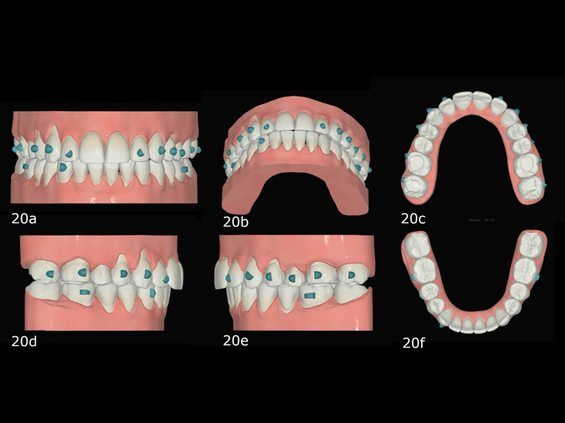 Figs. 20a–f: Final planned occlusion after the second phase of aligner treatment in FAS OcclusalDesign.
