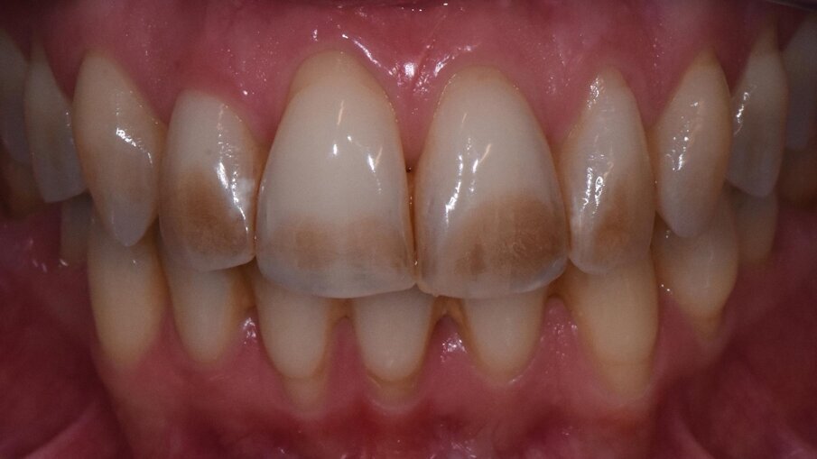 Fig. 6 - Denti fortemente pigmentati al controllo di 6 mesi e dopo la lucidatura delle superfici.