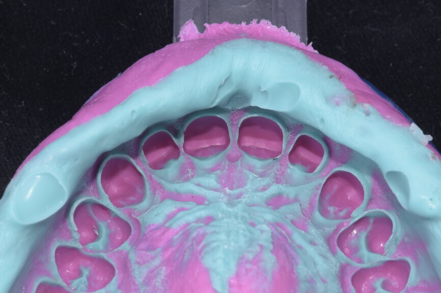 Fig. 59: Final impression.