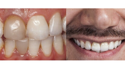 Dinámica lumínica en dientes anteriores con cerámica vítrea