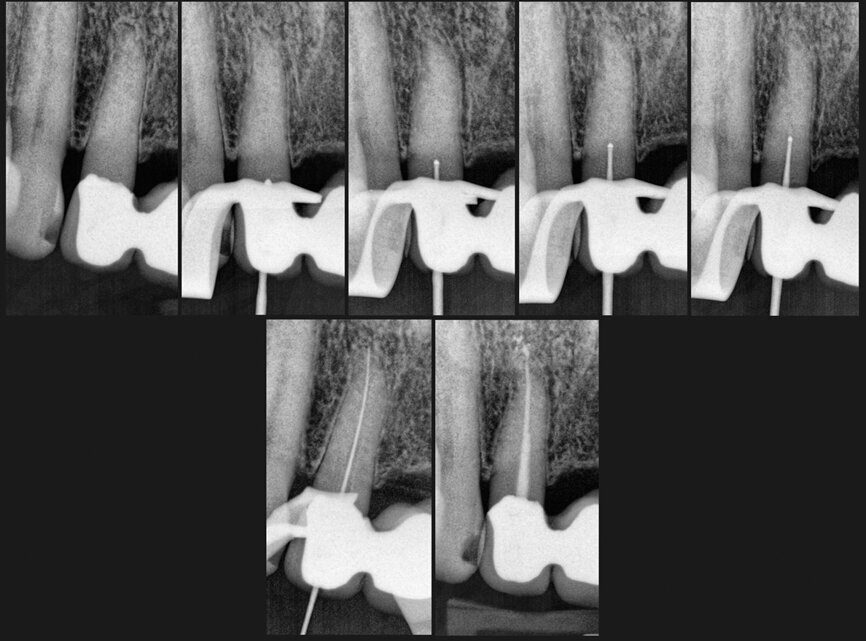 Using the Munce Discovery Burs. (Photo: CJM Engineering)