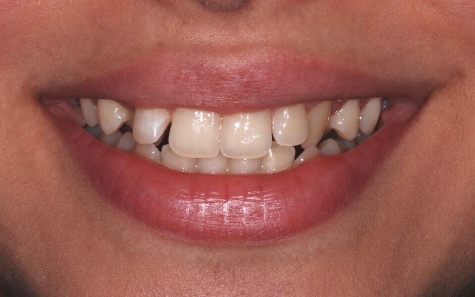 Fig. 5: Smile frontal view before treatment.