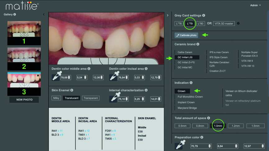 Fig. 2 : Vue intra-orale, montrant la préparation dyschromique