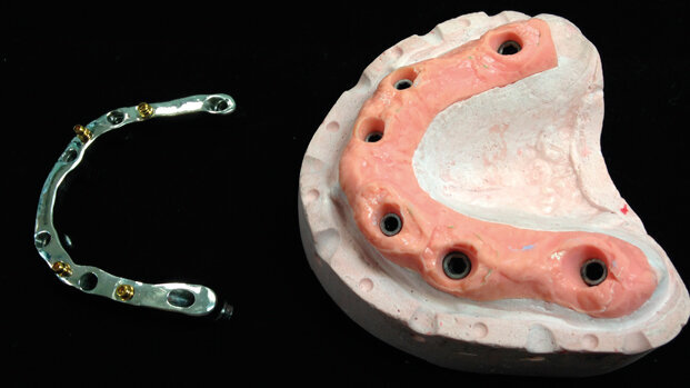 Soluzioni digitali per una protesi su barra