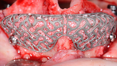 Ricostruzione tridimensionale di un’arcata superiore edentula