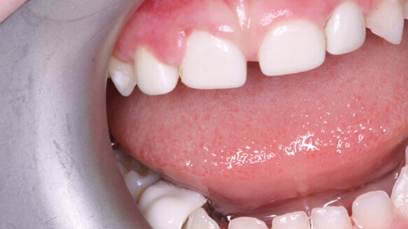 Shofu announces capsule delivery system for two of its products