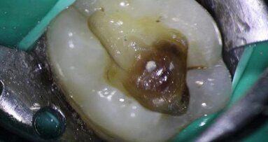 Diagnosis and management of a longitudinal fracture necrosis associated with an extensive periodontal defect