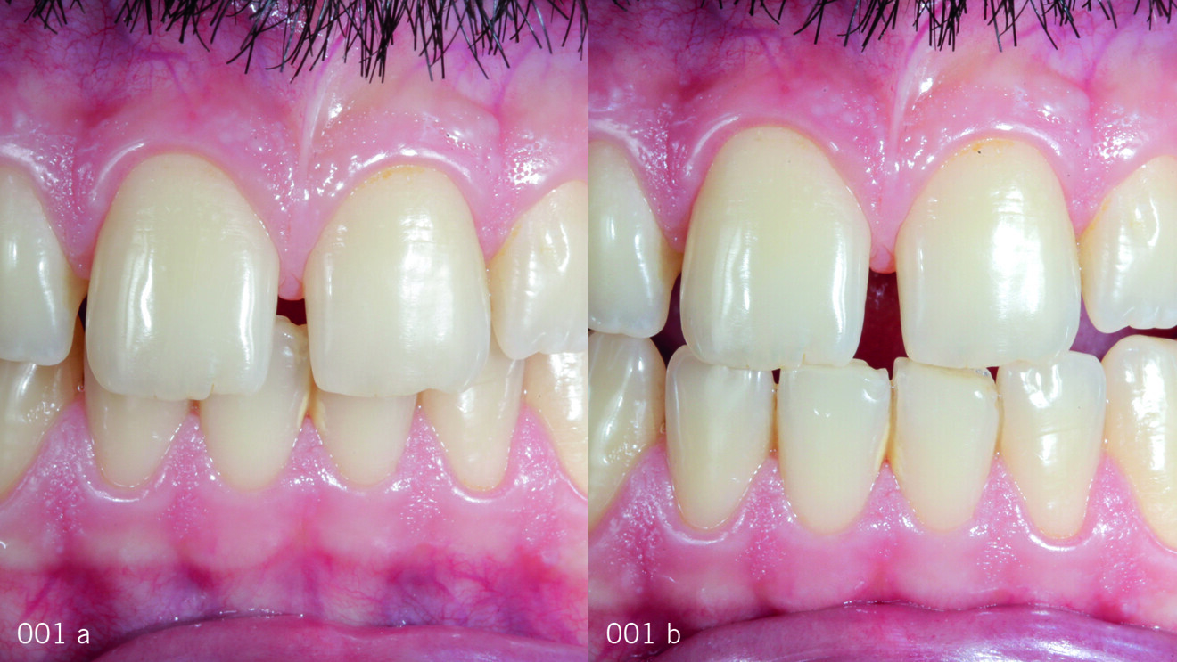 Figs. 1a,b: Initial situation. Teeth in intercuspal position and teeth in protrusion, frontal view.