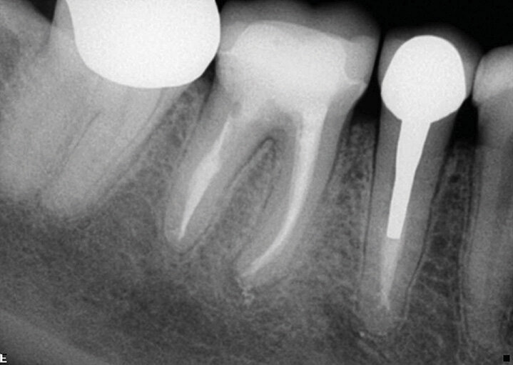 Slučaj 2 – Slika br. 6: Periapikalni kontrolni Rtg snimak nakon godinu dana od tretmana