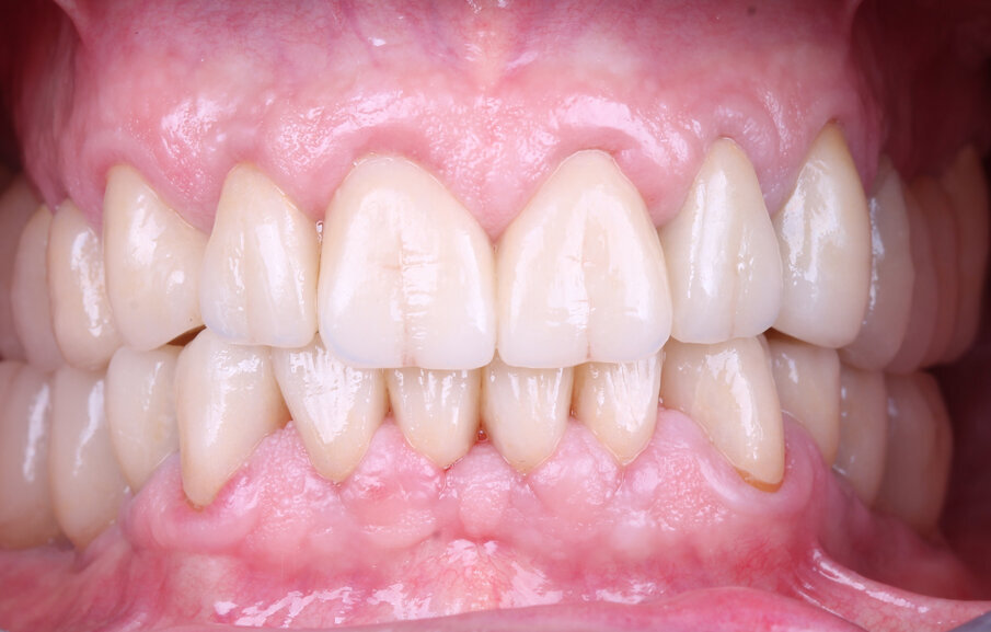 Fig. 28: Situation after placement of the all-ceramic restorations
