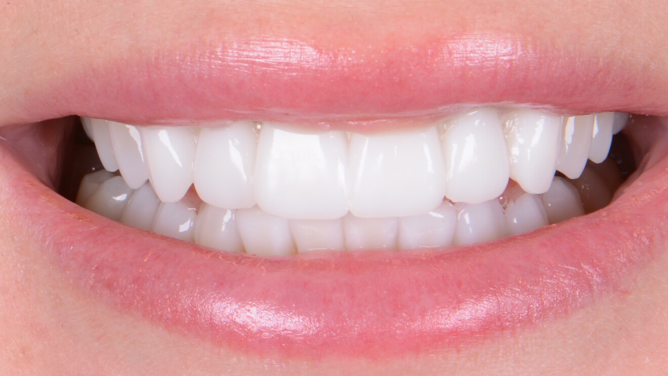 Fig. 5: Wax-up transferred to the patient’s mouth for functional and aesthetic analysis.