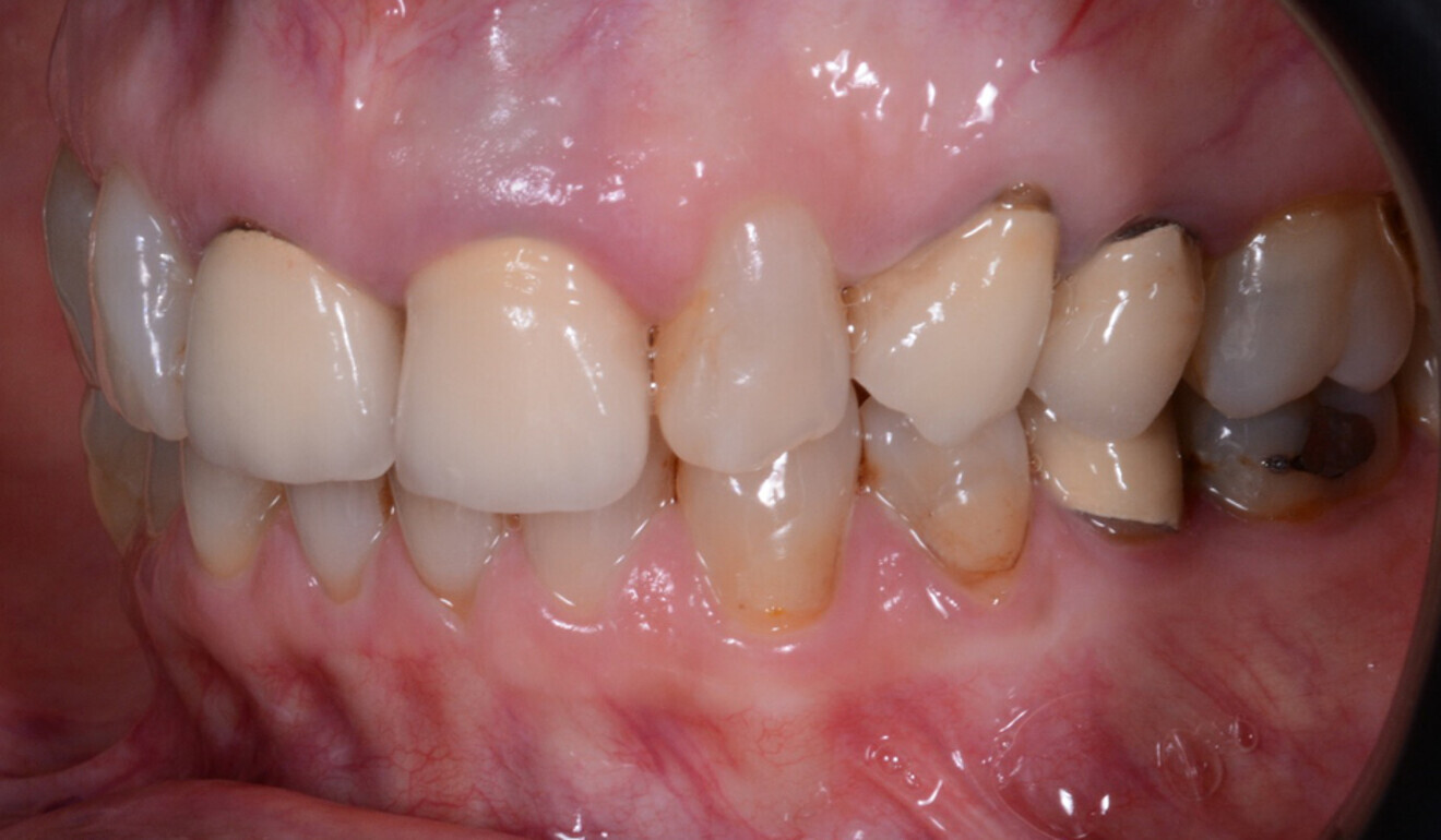 Fig. 4: Lateral view of the maxillary and mandibular left quadrants.