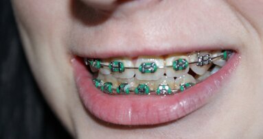 Profilaktyka próchnicy podczas leczenia ortodontycznego