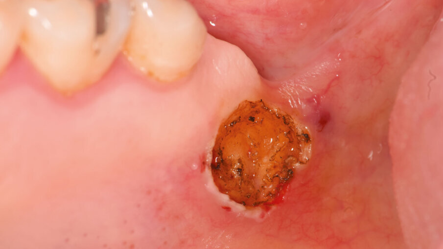 Fig. 3 - Cratere residuo dopo escissione con laser.