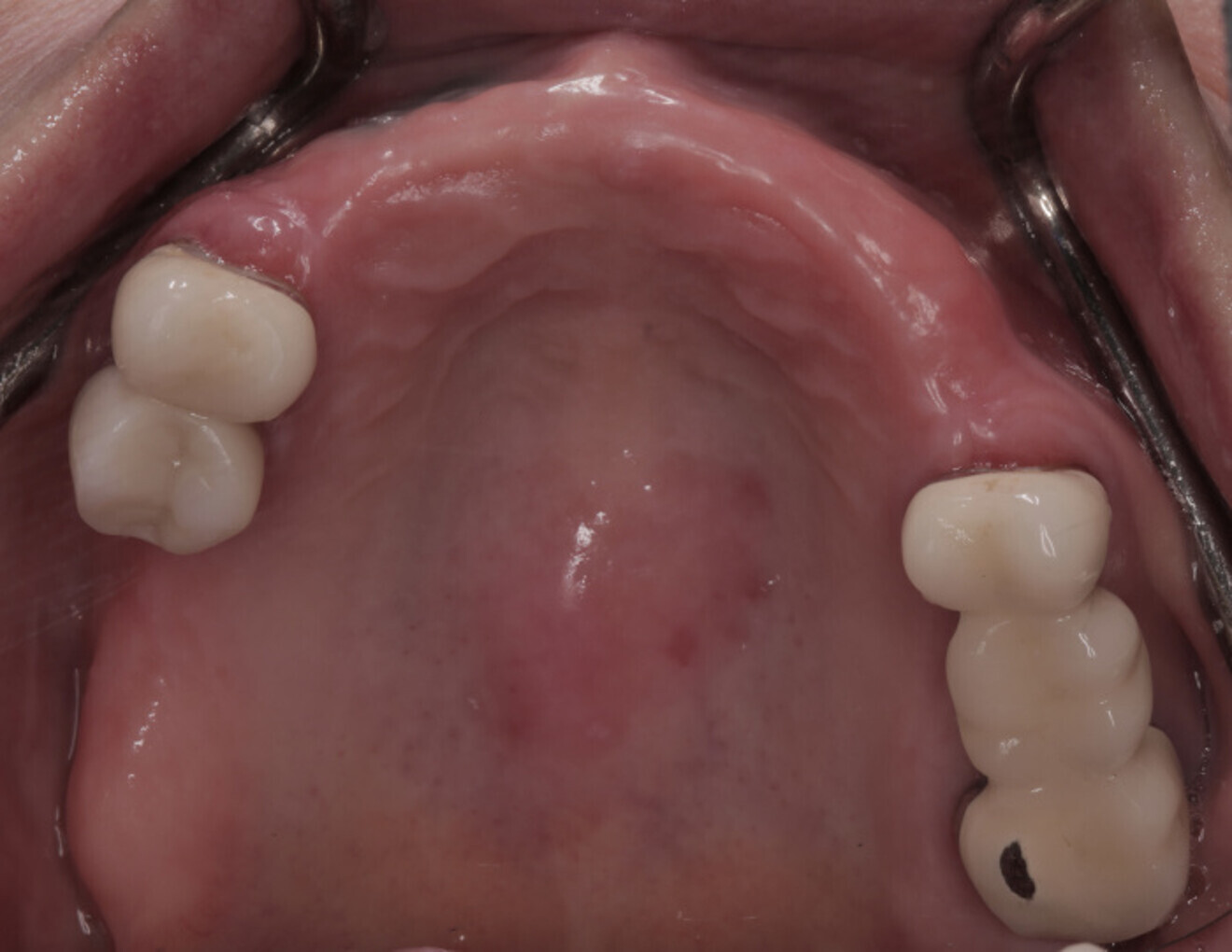 Fig. 3a: Occlusal view of the initial presentation without the partial acrylic denture.