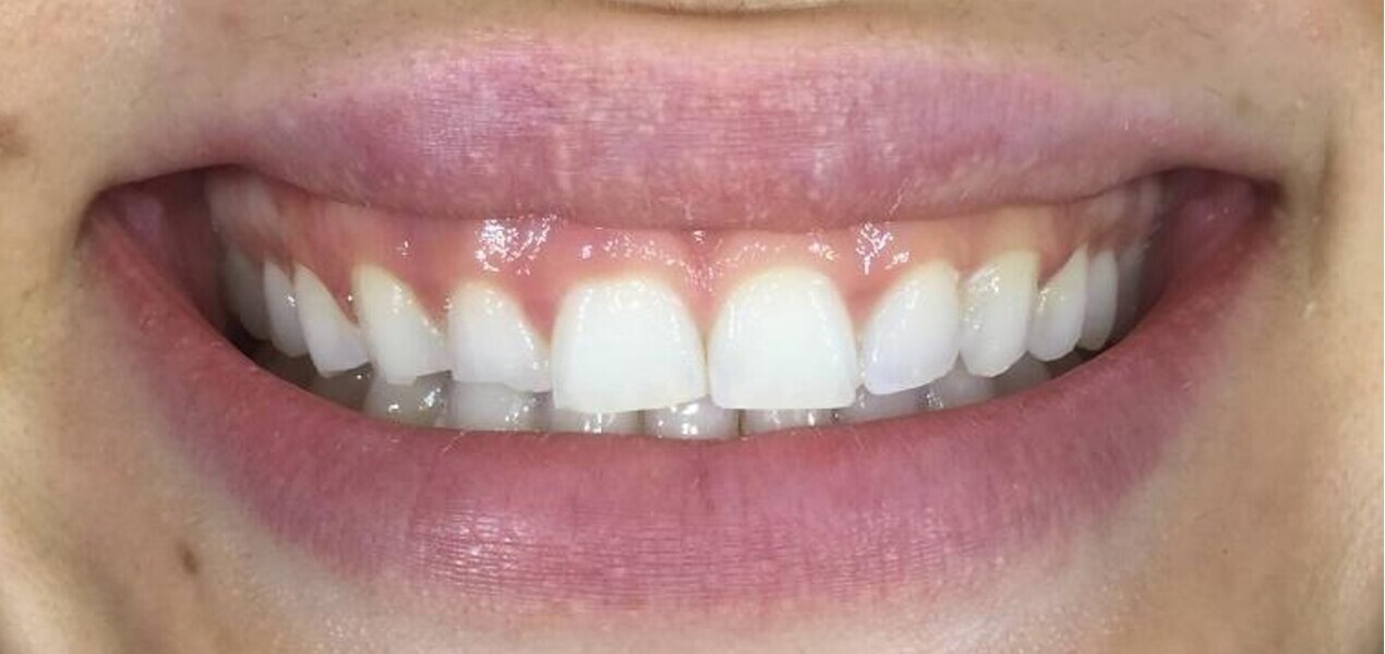 Fig. 6: Close-up view of the patient’s smile after aligner treatment.