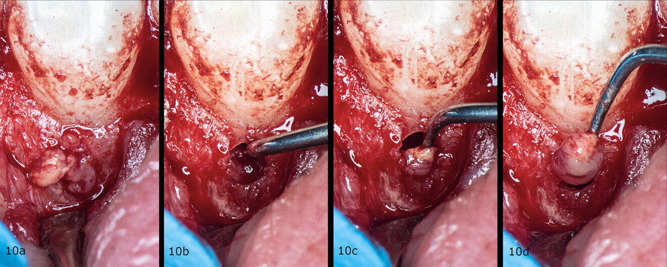 Figs. 10a–d: Removal of the granulation tissue step by step.
