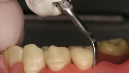 Στρατηγικές για εργονομική χρήση των εργαλείων ριζικής απόξεσης