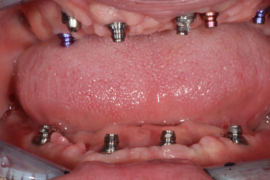 Fig. 8_Situazione clinica dei tessuti molli a distanza di due mesi dall’inserimento degli impianti.