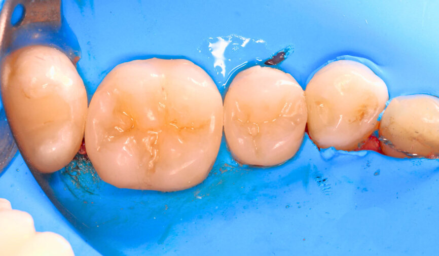 Fig. 8: An aesthetic gloss emerges from beneath the particles, and this can be achieved using thin nylon brushes or brushes made from natural goat hair.