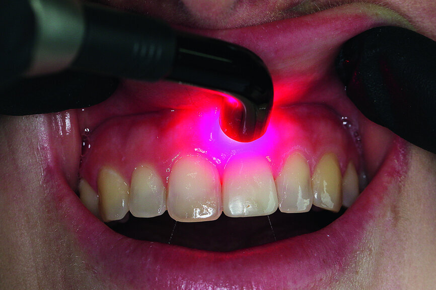 Fig. 15: Situation after one week: activation of wound healing with a soft laser of 660 nm.