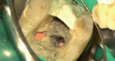 Reendodontické ošetrenie dolného molára