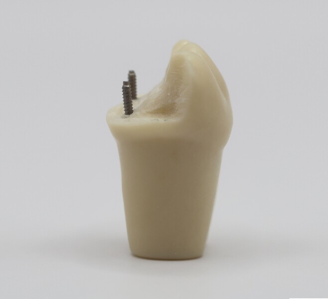 Fig. 7b: Completed pinlay preparation on tooth #36 after removal from the dentoform arch, shown in mesial view. 