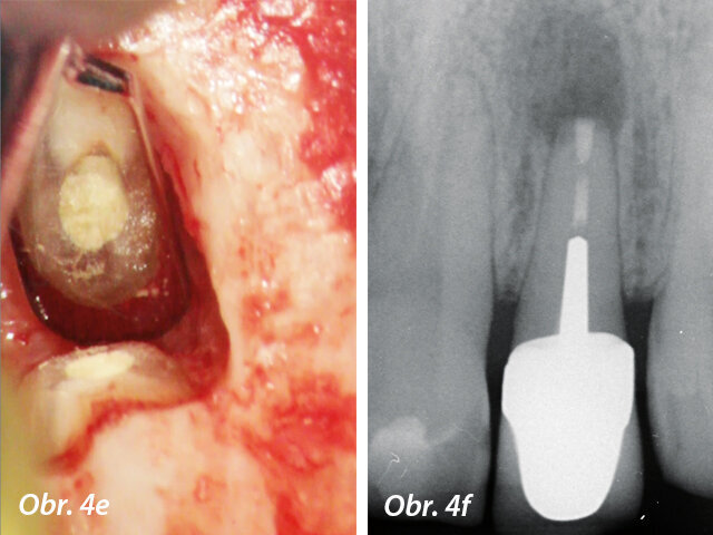 Pohled přes zrcátko - MTA výplň v apikální části a postoperační RTG s apikální výplní