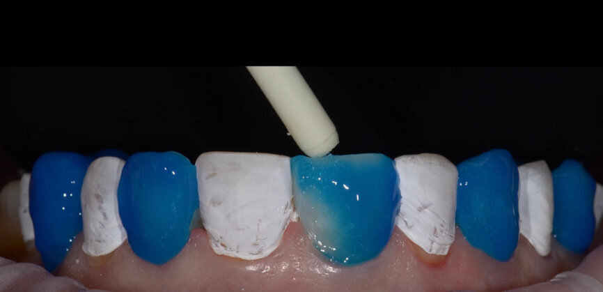 Fig. 7: A surgical suction tip was used to carefully remove the phosphoric acid gel and protect the isolations on the teeth, followed by rinsing off completely with water in the usual manner. 