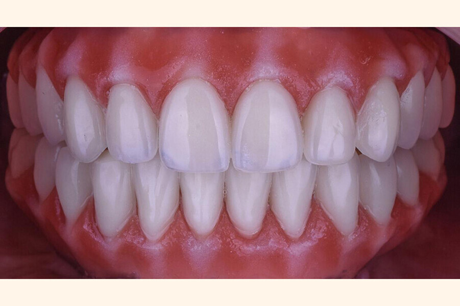 Fig. 23. Rx Pre-operatoria, Prótesis híbrida inmediata con 5 años de evolución y Rx Control a los 5 años.