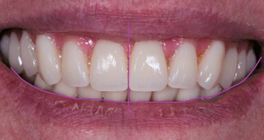 Restauri implantoprotesici: la sfida di creare un sorriso esteticamente gradevole  in un paziente edentulo