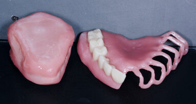 Digitálně vyrobený obturátor  s využitím virtuálních dat a 3D tisku