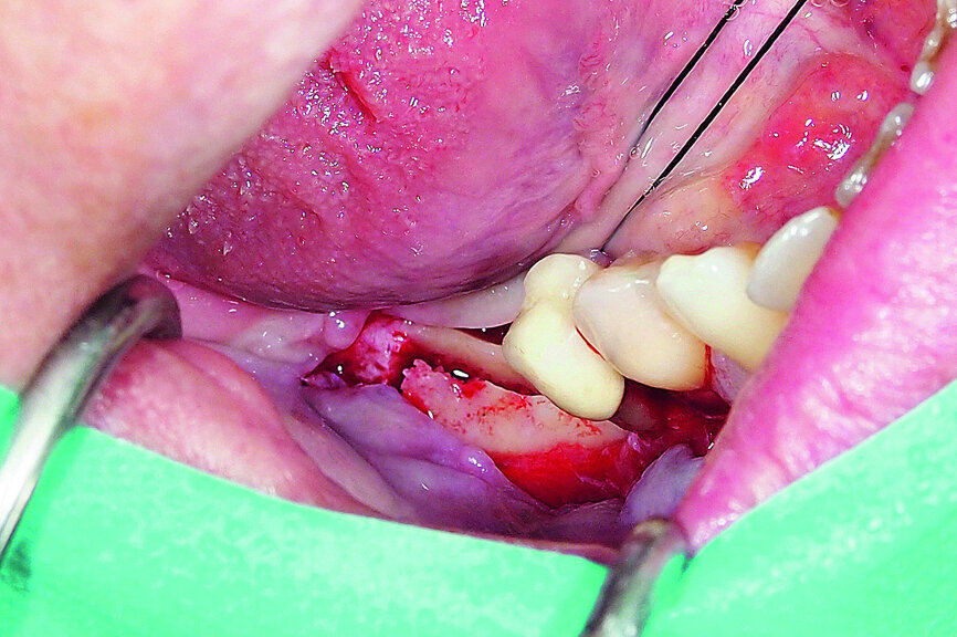 Fig. 16: Mandibular ridge splitting with  vertical cuts.
