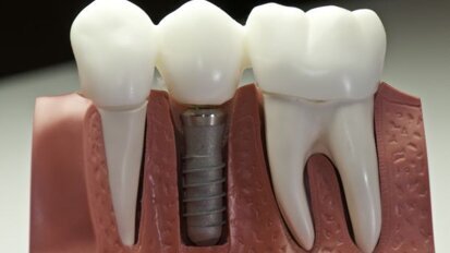 Gel stimuleert botgroei rond implantaat