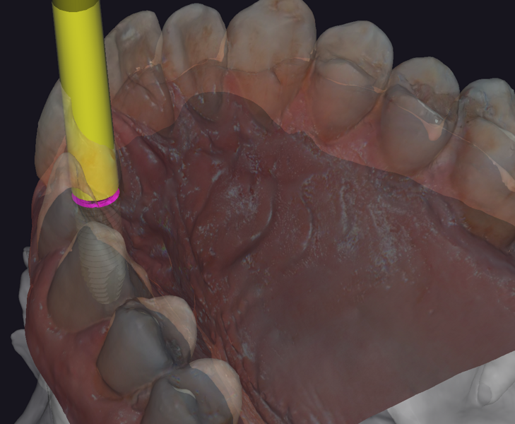 Fig. 8b: Virtual implant placement in exoplan in region #11, showing the location relative to the adjacent crowns and roots, lateral view.