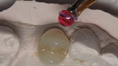 Cementazione di corona facilitata  dal dispositivo Triodent Griptab