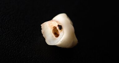 Nieuwe studie naar cariëspreventie pleit voor gecombineerde behandeling